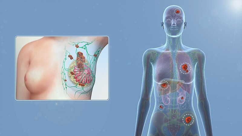 Stage 4 of Breast Cancer, tags: la - CC BY-SA